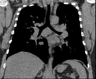 Subcarinal 8. Paraesophageal 9.