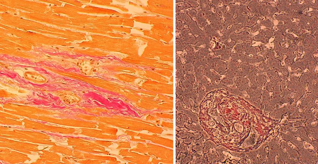 KUVA 2. Vasemmalla Weigert van Gieson -värjäys sydänlihaskudoksesta. Oikealla hopeavärjäyksiin kuuluva retikkelivärjäys maksasta. Kudosleikkeissä värjättäviä hiilihydraatteja ovat glykogeeni ja limat.