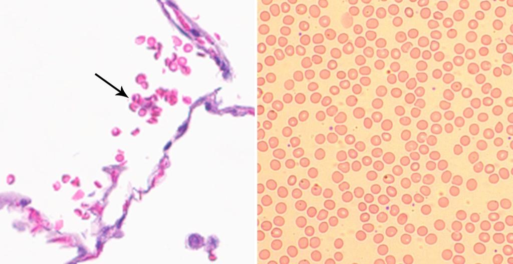 KUVA 22. Vasemmalla punasoluja histologisessa näytteessä. Oikealla punasoluja veren sivelyvalmisteessa.