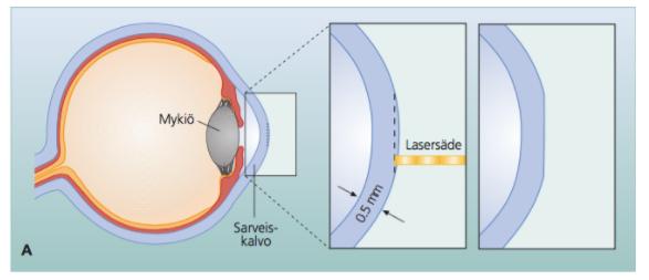 16 4.1 PRK (Photorefractive Keratectomy) PRK-leikkausmenetelmässä sarveiskalvon epiteeli poistetaan joko mekaanisesti, alkoholilla tai laserilla (Transepithelial photorefractive keratectomy, T-PRK).
