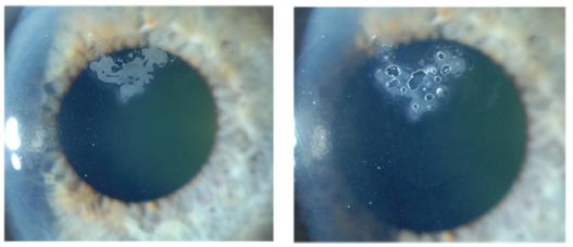 Ensimmäinen kuva epiteelin liikakasvusta läpän alla ja toinen kuva on otettu samasta silmästä korjausleikkauksen jälkeen. (Rapuano n.