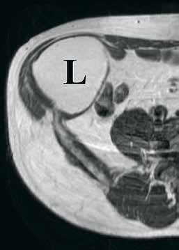 KUVA 3. Oikealla alavatsalla vatsanpeitteiden lihaksensisäinen lipooma (L), jossa ei todeta magneettikuvauksessa pahanlaatuisia piirteitä. tuisista kasvaimista ei pidetä rekisteriä.