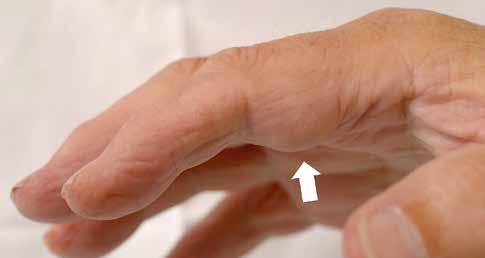 A B C D KUVA 5. A) 77-vuotias mies huomasi oikeassa etusormessaan 1,5 cm:n kokoisen kivuttoman patin (nuoli), joka oli välillä arka.