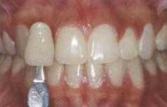 Annostele halutessasi 2 % Desensibilize -hampaiden desensitointigeeli