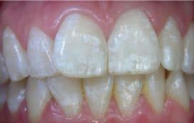 Poistaa hampaan pinnalta esimerkiksi fluoroosin ja