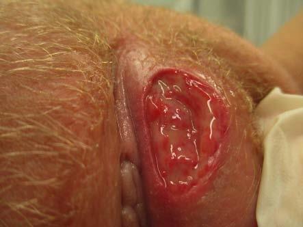 Kirjallisuutta 1 Hernandez-Nunez A, Cordoba S, Romero-Mate A, Minano R, Sanz T, Borbujo J. Lipschütz ulcers - four cases. Pediatr Dermatol 2008;25:364 7. 2 Huppert J.