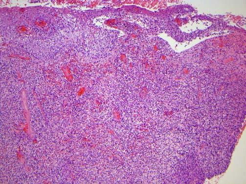sista puna- (lichen planus) ja valkojäkälä (lichen sclerosus) voivat esiintyä erosiivisina (taulukko 1). Diagnostiikka Potilaan huolellinen haastattelu on diagnostiikan kulmakivi.