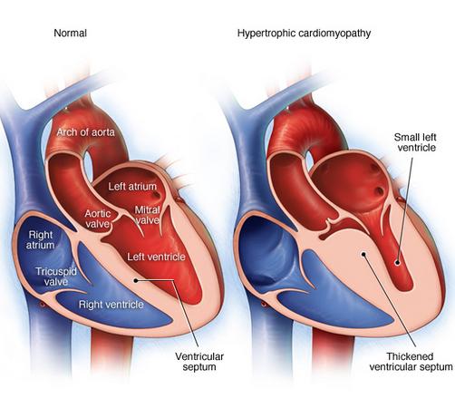 Hypertrofinen kardiomyopatia Vasemman kammion ulosvirtauskanavan obstruktio (HOCM) SAM (systolic