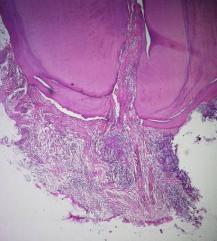 Follikulaarikysta (cysta follicularis, dentigerous cyst) 34. Yläleuan postoperatiivinen kysta 35. Nasolabiaalikysta (cysta nasolabialis, nasoalveolar cyst) 36.