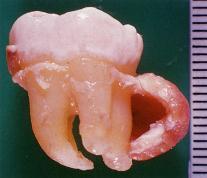 histologian kanssa Typing of Odontogenic Tumours Lateraalinen parodontaalikysta (Botryoidi