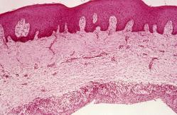 Follikelikysta: yleistä (follicular cyst, dentigerous cyst) Kystaepiteeli Kystaontelo 33.