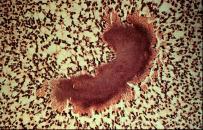 kolonnat histologisessa leikkeessä (= AML-kolonnat) gram + gram + (tummansininen) gram+ anaerobi