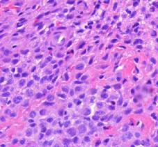 tulehdussolujen infiltraatti, runsaasti eosinofiilisiä granulosyyttejä sekä Langerhansin soluja joissa kahvipapumaiset tumat Immunohistologinen tutkimus