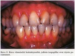 Lisäksi hänelle määrättiin Flagyl 400 mg, ohjeella 1 x 3 x 10.