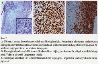 Hampaiden 21-22 välinen papilla otettin kokonaisuudessaan koepalaksi (Kuva 2) potilaalta suljettiin pois veritautien mahdollisuus sekä HIV-infektio.