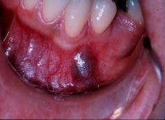 Lymfangiooma 46. Angioleiomyooma 47. Neurofibrooma 48. Schwannooma (neurilemmooma) 49.