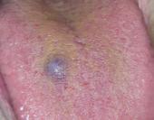 Luutuva fibrooma Luutuva fibrooma on todellinen neoplastinen muutos, jolla huomattava kasvupotentiaali.