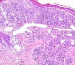 Luu lamellaarista. Osteoblasteja Rajoittunut ympäröivästä luusta fibroottisella kapselilla (diff.dg.