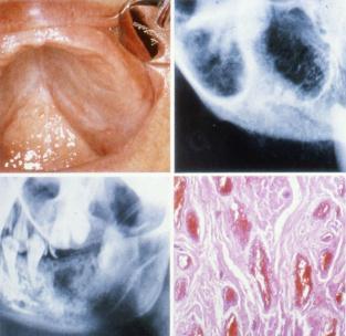 Hemangiooma: histopatologia Synnynnäisiä sinipunaisia, litteitä, nodulaarisia tai kuhmuraisia
