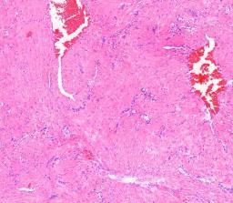 sidekudostilaa Angioleiomyooma on leiomyooman histologinen alatyyppi Leiomyooma on suussa harvinainen