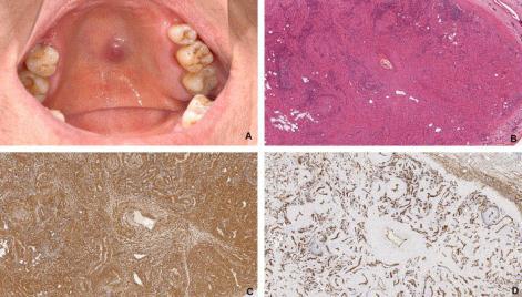 Voi muistuttaa erehdyttävästi neurofibroomaa, shwannoomaa, fibromatoosia tai myofibroomaa.
