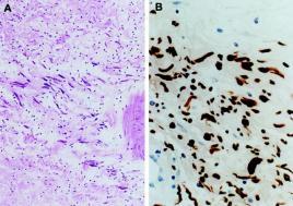 järjestäytyneinä kimppuina esiintyvää sileää lihasta 47. Neurofibrooma: yleistä 47.
