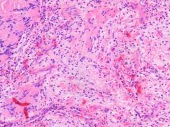 (nuolet) Sukkulamaisia Schwannin soluja jotka järjestäytyneet palisadimaisesti eosinofiilisten