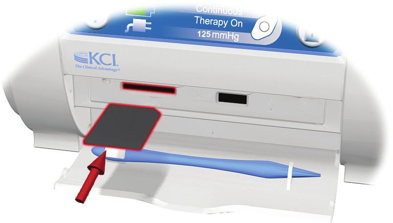 Muistikorttisiirto-näyttö Muistikorttipaikka on tarkoitettu ainoastaan lääkärin käyttöön. 1. Aseta muistikortti INFOV.A.C..-hoitoyksikön muistikorttipaikkaan.