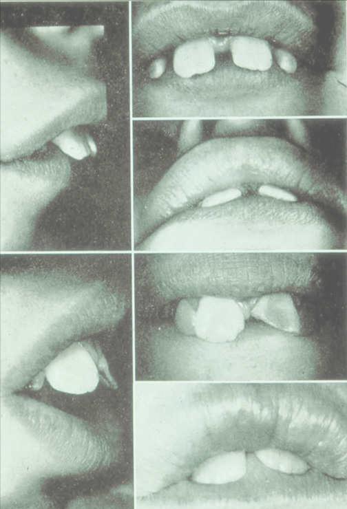 4) Huulisulku vaikeaa, alahuuli rullautuu yläetuhampaiden taakse huuli toimii
