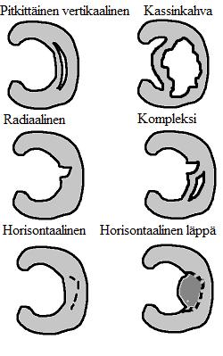 4. halkio (horisontaalinen) 5. kompleksi repeämä. Nivelkierukkavammojen luokittelusta on tehty kattava tutkimus vuonna 2011 [31].