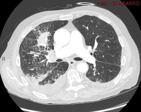 Keuhkomuutosten näytteenottotavat TT/UÄ ohjattu biopsia ONB/PNB Bronkoskopia ONB/biopsia VATS=video assisted thoracoscopic