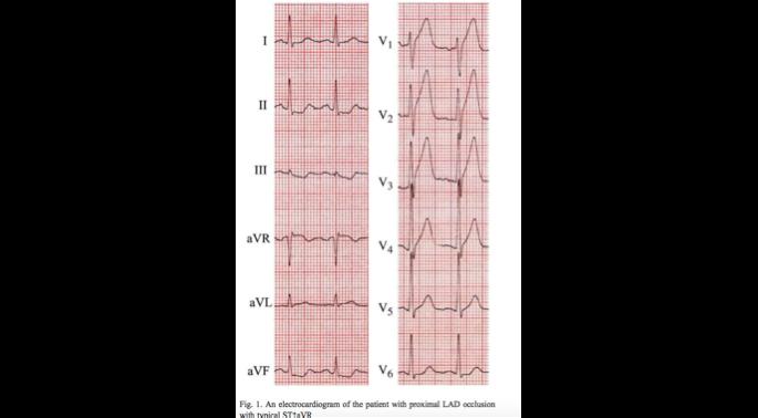 Widow maker - ekg J Cardiovasc Med 2018: 48 potilaasta joilla