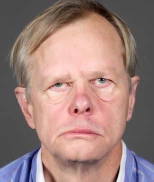 14 Pihlamaa T, Rautio J, Kiuru-Enari S, Suominen S. Gelsolin amyloidosis as a cause of early aging and progressive bilateral facial paralysis. Plast Reconstr Surg 2011;127:2342 51.
