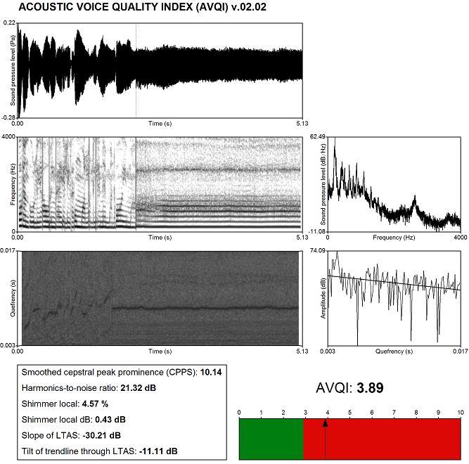 Kuvio 1. Esimerkki erään tähän tutkimukseen osallistuneen puhujan AVQI-analyysin tulosteesta. AVQI-arvo on 3,89, mikä kertoo häiriintyneestä äänestä.