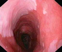 histologisen diagnoosin koskemaan intestinaalista metaplasiaa (10).