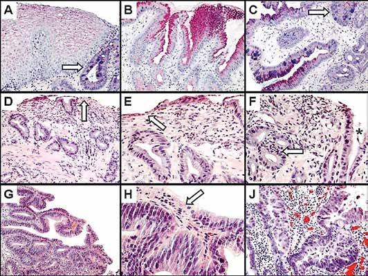 KATSAUS KUVA 3. A) Normaalia ruokatorven levyepiteeliä ja intestinaalista metaplasiaa (nuoli) (AB-PAS-värjäys). B) Ruokatorven gastrinen metaplasia (AB-PAS-värjäys).