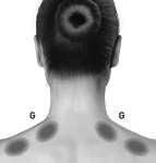 D. m. temporalis: 5 yksikköä/ injektiokohta ( 2 lisäinjektiokohtaa) E: m. occipitalis: 5 yksikköä/ injektiokohta ( 2 lisäinjektiokohataa) G: m.