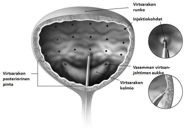 On suositeltavaa, että potilas lopettaa antitrombosyyttihoidon ainakin 3 päivää ennen injektiota. Jos potilas saa antikoagulanttihoitoa, verenvuotoriskin pienentämisestä on huolehdittava.