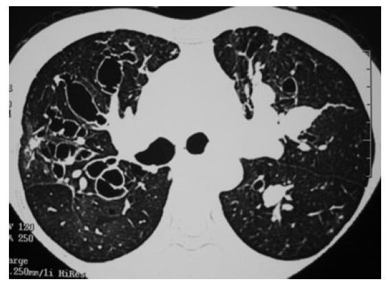 Diagnostiset testit - HRTT Bronkiektasiat (sentraaliset,