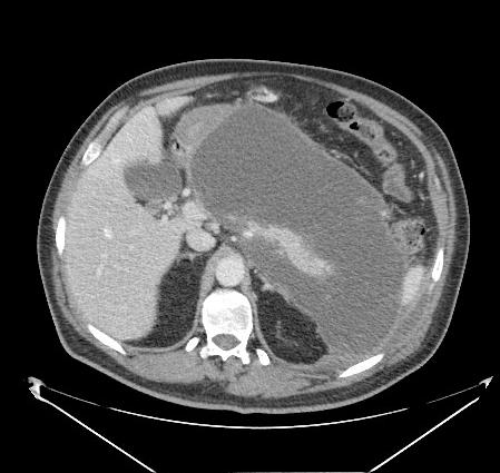 8 Hollemans RA, Bollen TL, van Brunschot S ym. Predicting success of catheter drainage in infected necrotizing pancreatitis. Ann Surg 2016;263:787 92. 9 Nikkola J, Räty S, Laukkarinen J ym.