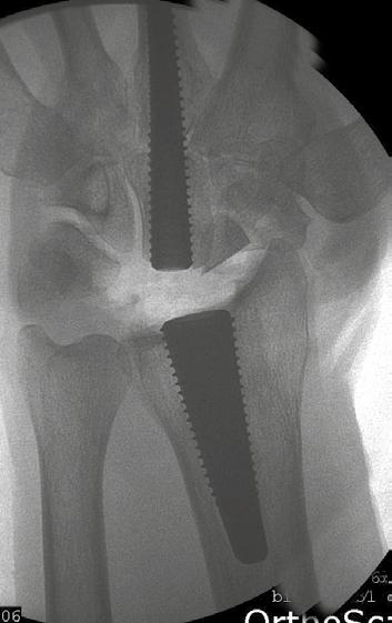 Radius Cup Trial -osa asetetaan Radius Threaded Implant -osaan. Älä käytä Trial-koepalan asettamiseen iskulaitetta.