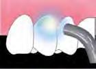 Annostelu Aplikointi, 10 s odotus 5 s kevyt puustaus 5 s voimakas puustaus 10 s valokovetus Preparoidun hampaan