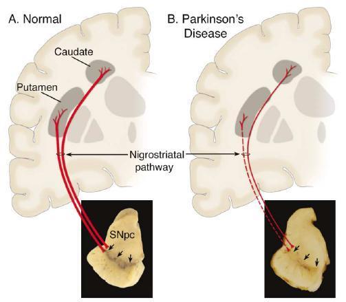 Etenevä neurodegeneratiivinen liikesairaus Dopamiinineuronit tuhoutuvat mustatumakkeessa (substantia nigra) Parkinsonin tauti (PT) Oireet: liikkeiden hitaus, lepovapina, jäykkyys ja