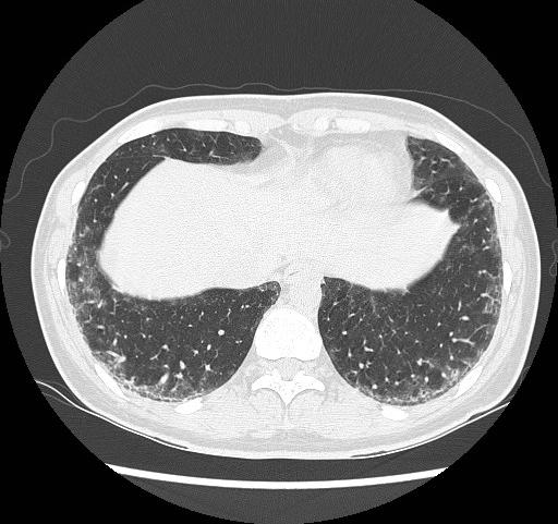 Liitekuva 1. Sklerodermaan liittyvä epäspesifinen interstitiaalinen pneumonia (NSIP). Basaalipainotteinen, mattalasimainen retikulaatio, joka säästää aivan subpleuraalialueen.