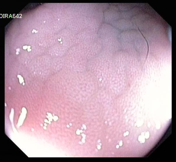 focal eosinophilic component Body (multifocal): severe edema, moderate