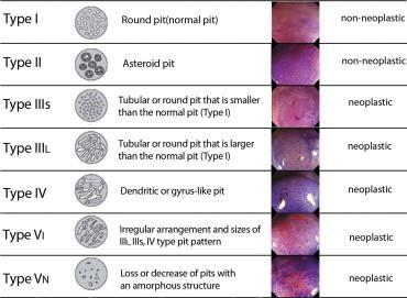 Colonoscopy(human) Kudo pit