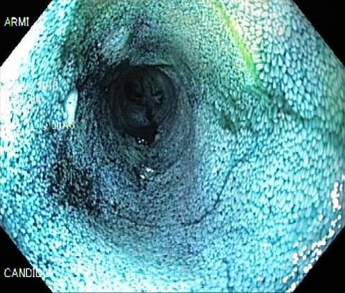 Chromoendoscopy Preparation Excellent patient preparation is mandatory for enhanced mucosal visualization!