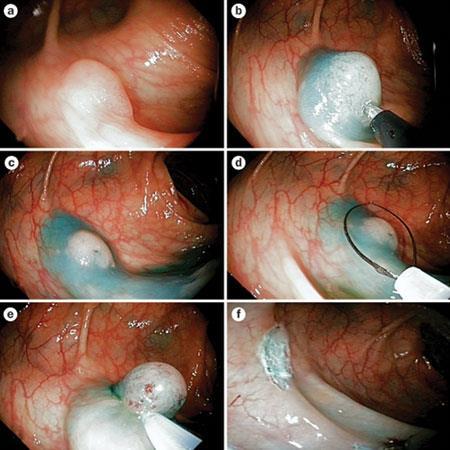 Curative endoscopic treatments Contrast enhancement