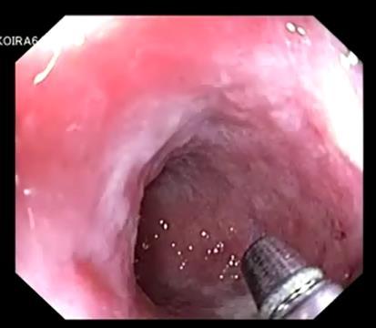 Chromoendoscopy Principle Spraying the mucosa with color to enhance