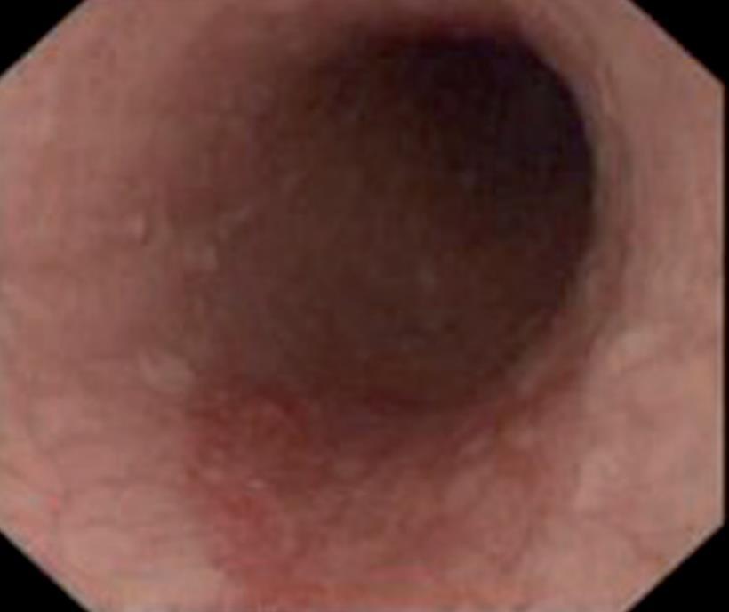 Esophagoscopy (human)